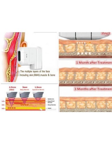 HIFU Rejuvenecimiento  Facial 2 en 1