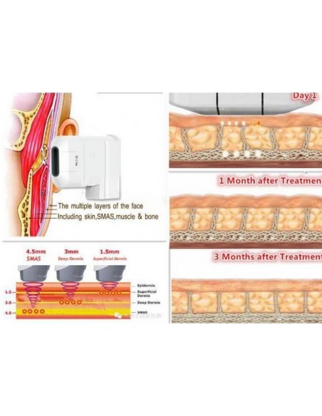 HIFU Rejuvenecimiento  Facial 2 en 1