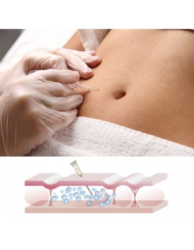 Carboxiterapia 2 kl