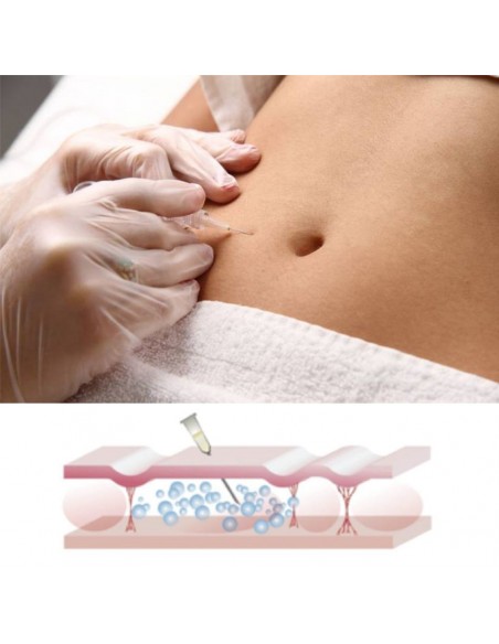 Carboxiterapia 2 kl