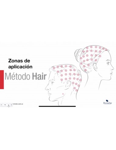 Método Hair dermclar para caída de cabello