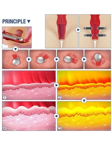 HIFU 7D  Facial y vaginal